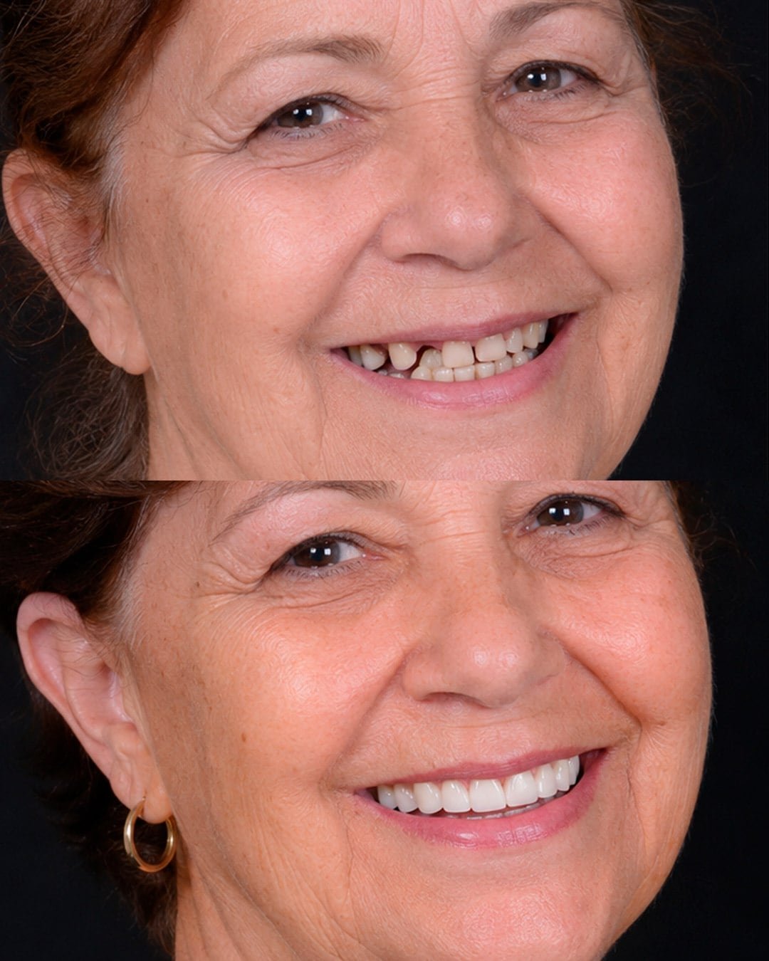 Comparativo de sorriso antes e depois de reabilitação oral