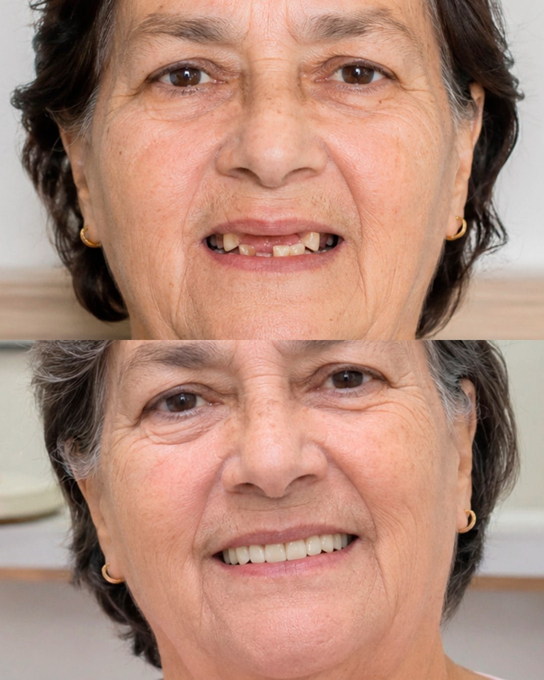 Comparativo de paciente antes e depois de reabilitação oral