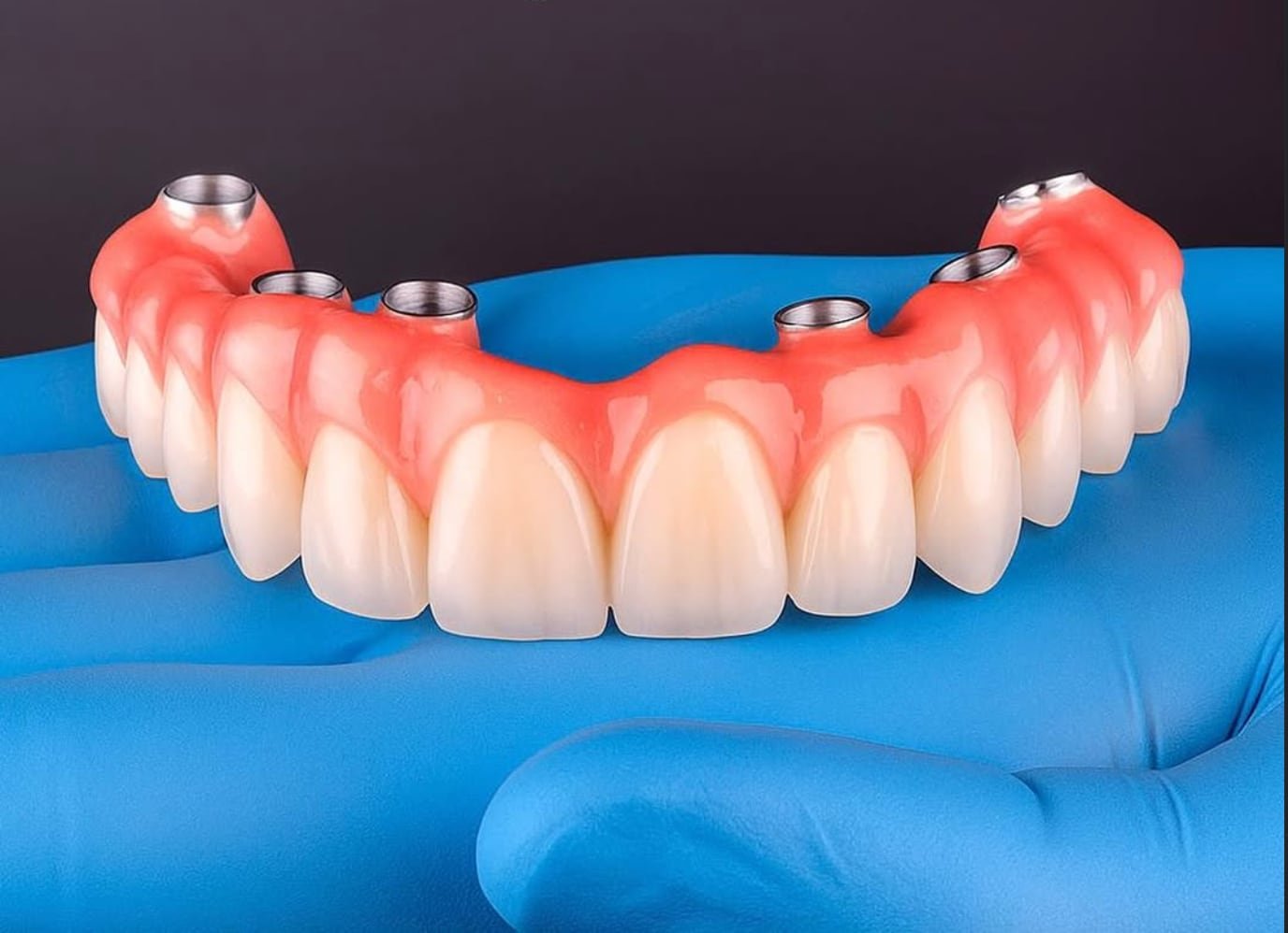 Representação de prótese protocolo sobre implantes