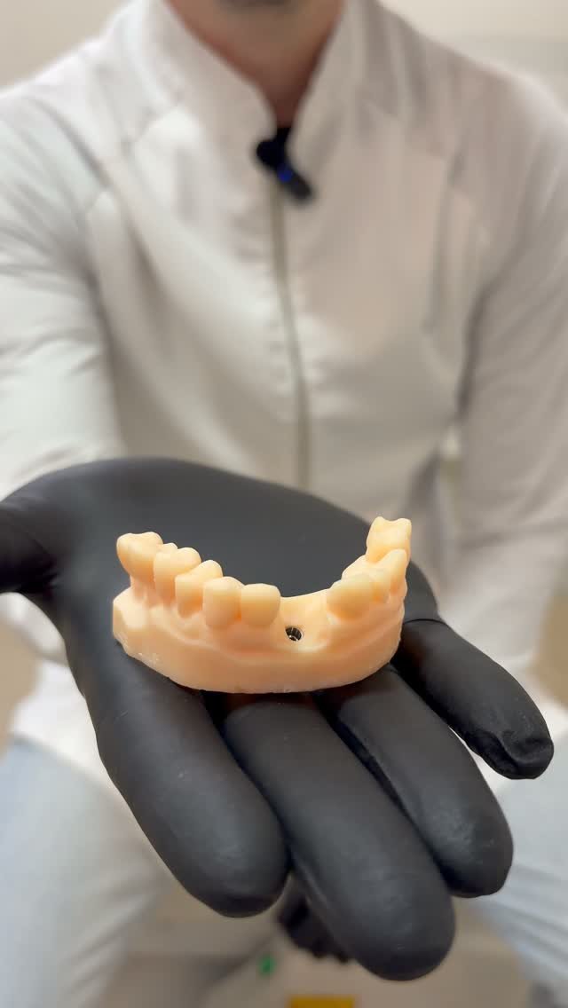 Prótese sobre implante apresentada pela Odonto Studio RP